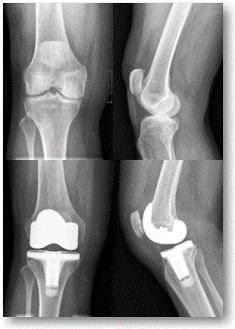 Knee X-rays